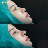 نتائج تجميل الأنف قبل وبعد في عيادة Vincent، إعادة تشكيل الأنف وتحسين المظهر الجانبي