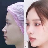 نتائج عملية تجميل الأنف قبل وبعد في عيادة Vincent، إعادة تشكيل الأنف لمظهر طبيعي