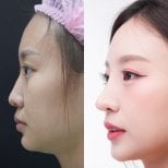 نتائج قبل وبعد عملية تجميل الأنف في عيادة Vincent مع مظهر طبيعي