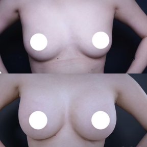 Resultados antes y después de aumento de senos en Vincent Clinic, forma y tamaño mejorados