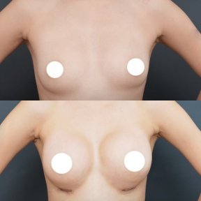 Resultados de aumento de senos antes y después en Vincent Clinic, mayor volumen mamario