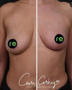 Résultats avant/après réduction mammaire à RENOVIUM CLINIC BY CEM CERKEZ MD, contour amélioré