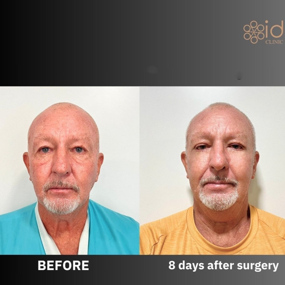 نتائج شد الوجه المصغر في ID Clinic Bangkok، تجديد مظهر الوجه خلال 8 أيام
