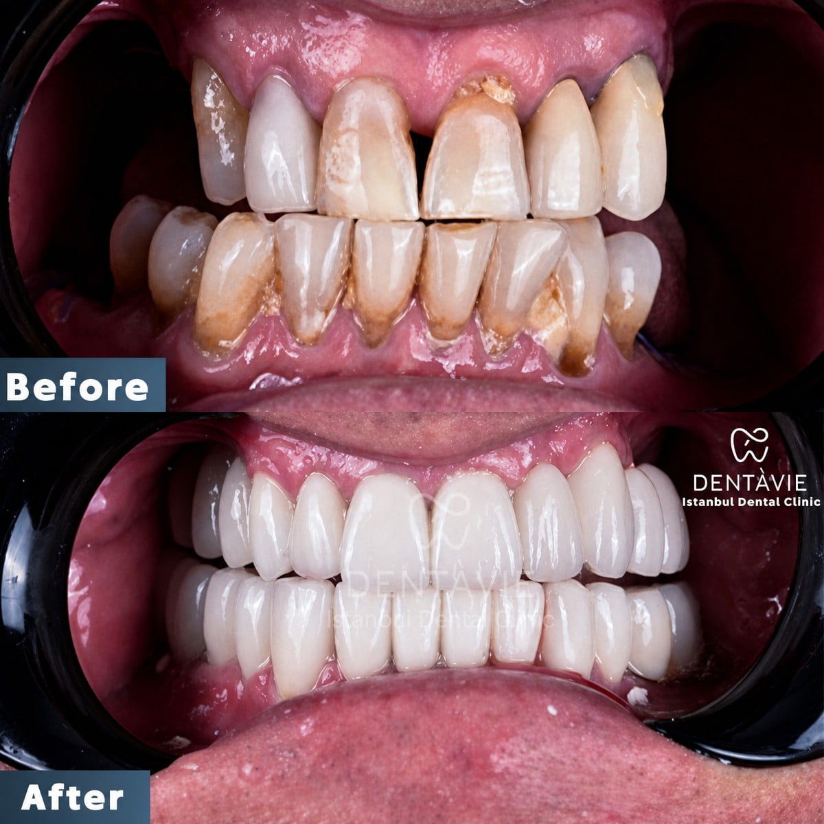 نتيجة قبل وبعد زراعة الأسنان All-on-4 في Dentavie Istanbul Dental Clinic، استعادة الابتسامة