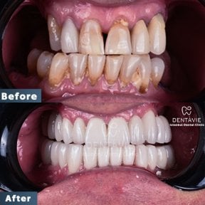Before and after All-on-4 dental implants result at Dentavie Istanbul Dental Clinic, smile restoration