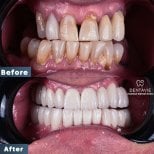 Before and after All-on-4 dental implants result at Dentavie Istanbul Dental Clinic, smile restoration