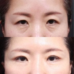 Before and after upper and lower eyelid surgery results at Returning Plastic Surgery clinic