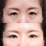 Before and after upper and lower eyelid surgery results at Returning Plastic Surgery clinic