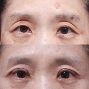 Before and after upper and lower eyelid surgery results at Returning Plastic Surgery clinic