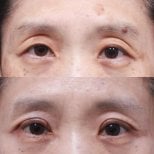 Before and after upper and lower eyelid surgery results at Returning Plastic Surgery clinic