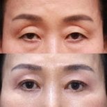 Before and after upper and lower eyelid surgery results at Returning Plastic Surgery clinic