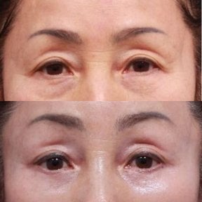 Before and after upper and lower eyelid surgery results at Returning Plastic Surgery clinic