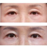 Before and after upper and lower eyelid surgery results at Returning Plastic Surgery clinic