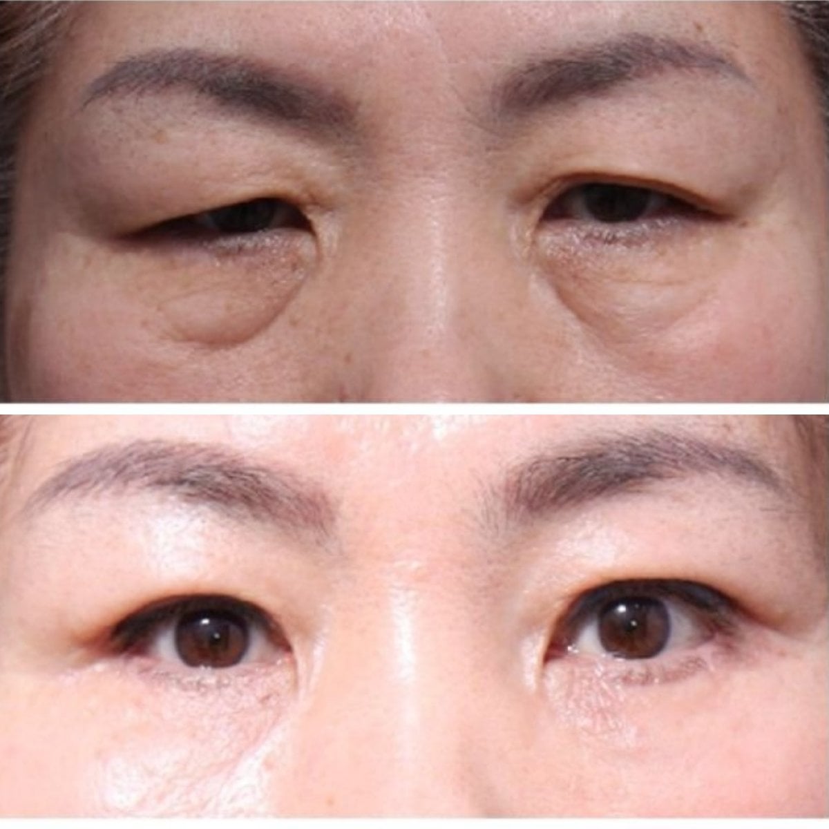 Resultados de cirugía de párpados superior e inferior en Returning Plastic Surgery