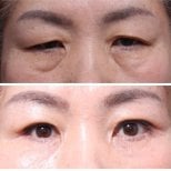 Before and after upper and lower eyelid surgery results at Returning Plastic Surgery clinic