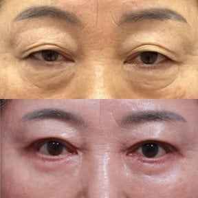 Before and after upper and lower eyelid surgery results at Returning Plastic Surgery clinic