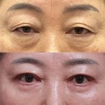 Before and after upper and lower eyelid surgery results at Returning Plastic Surgery clinic