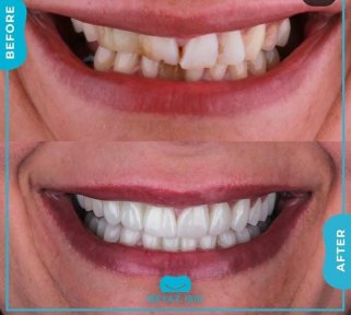 Smile Makeover Vorher-Nachher-Ergebnis bei Adem and Havva Medical Center, verbesserte Zahnstellung