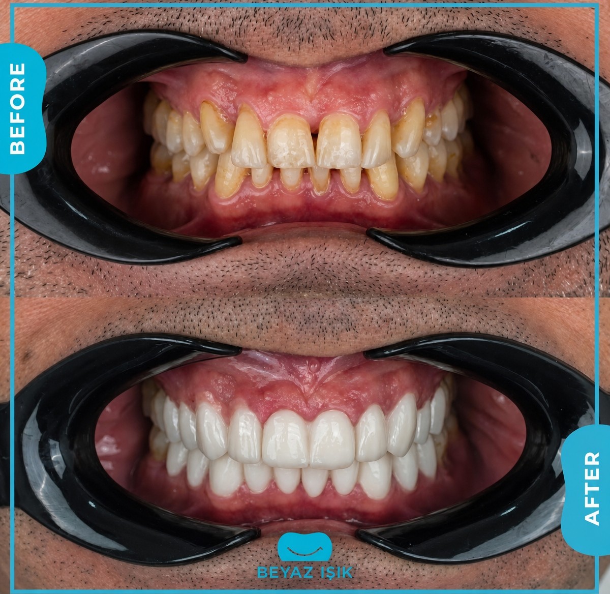 نتائج قبل وبعد تجميل الابتسامة في Adem and Havva Medical Center – أسنان بيضاء ومتناسقة