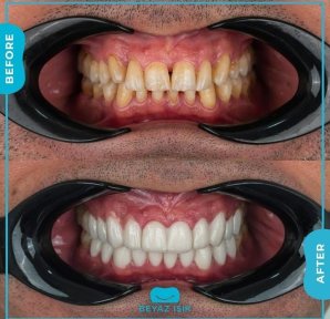 Smile-Makeover Vorher-Nachher-Ergebnis bei Adem and Havva Medical Center – weiße, gerade Zähne
