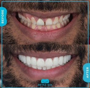 Smile-Makeover Vorher-Nachher-Ergebnis bei Adem and Havva Medical Center, weiße Zähne