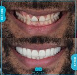 Smile-Makeover Vorher-Nachher-Ergebnis bei Adem and Havva Medical Center, weiße Zähne
