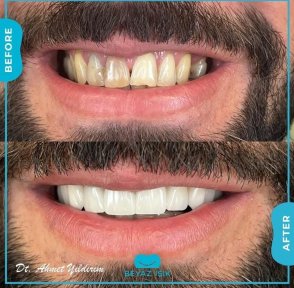 Smile Makeover Vorher-Nachher bei Adem and Havva Medical Center, weiße gerade Zähne