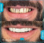 Smile Makeover Vorher-Nachher bei Adem and Havva Medical Center, weiße gerade Zähne