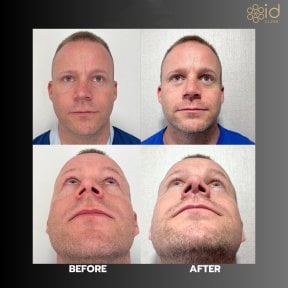 Before and after revision rhinoplasty results at ID Clinic Bangkok, improved nose shape