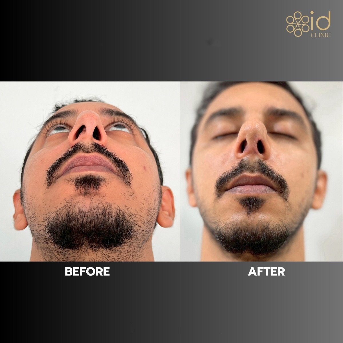 Resultado antes y después de rinoplastia de revisión en ID Clinic Bangkok, simetría nasal mejorada
