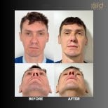Before and after revision rhinoplasty results at ID Clinic Bangkok, improved nose shape