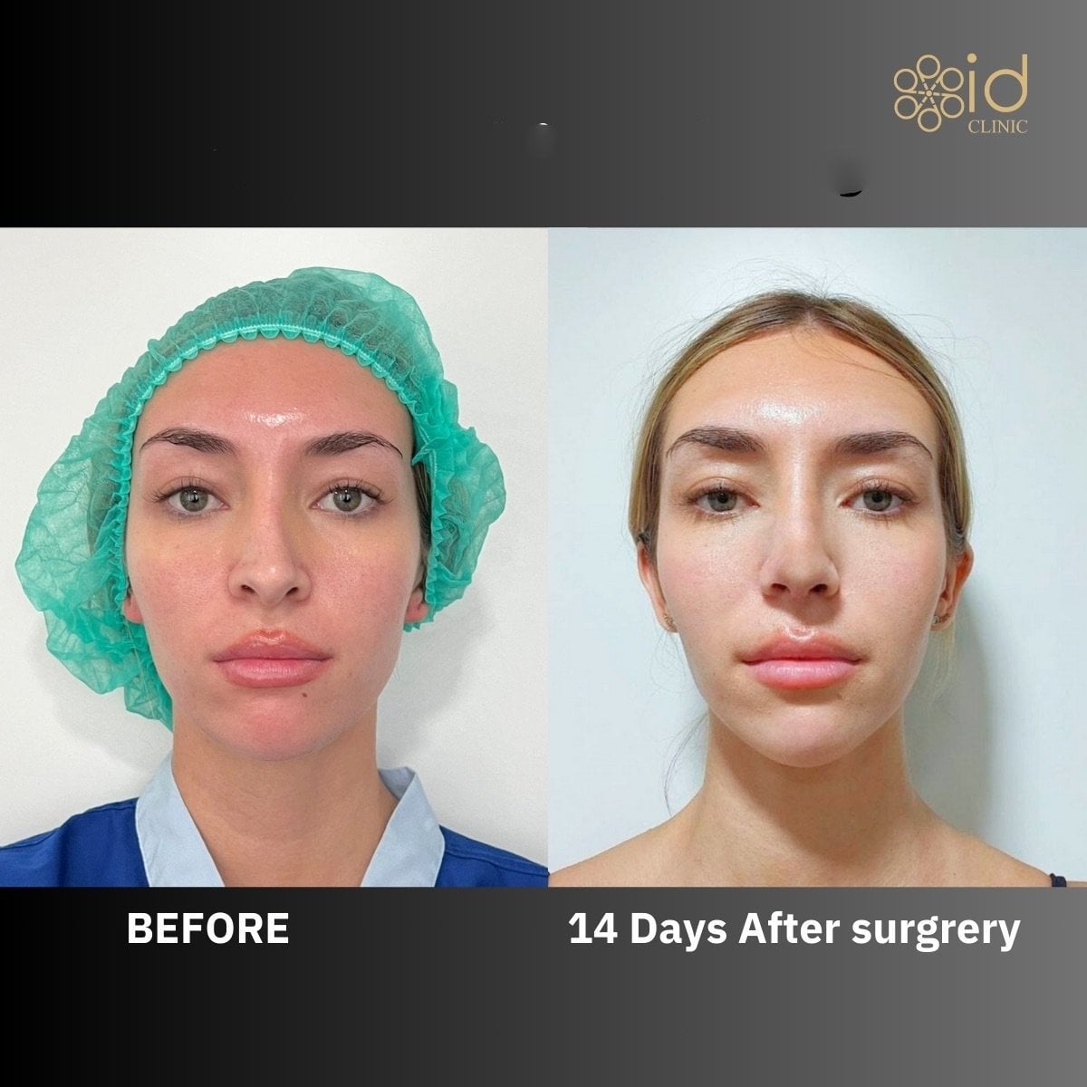 نتائج قبل وبعد عملية تجميل الأنف التصحيحية في ID Clinic Bangkok بعد 14 يومًا