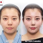 Before and after revision rhinoplasty results at Returning Plastic Surgery, improved nose shape
