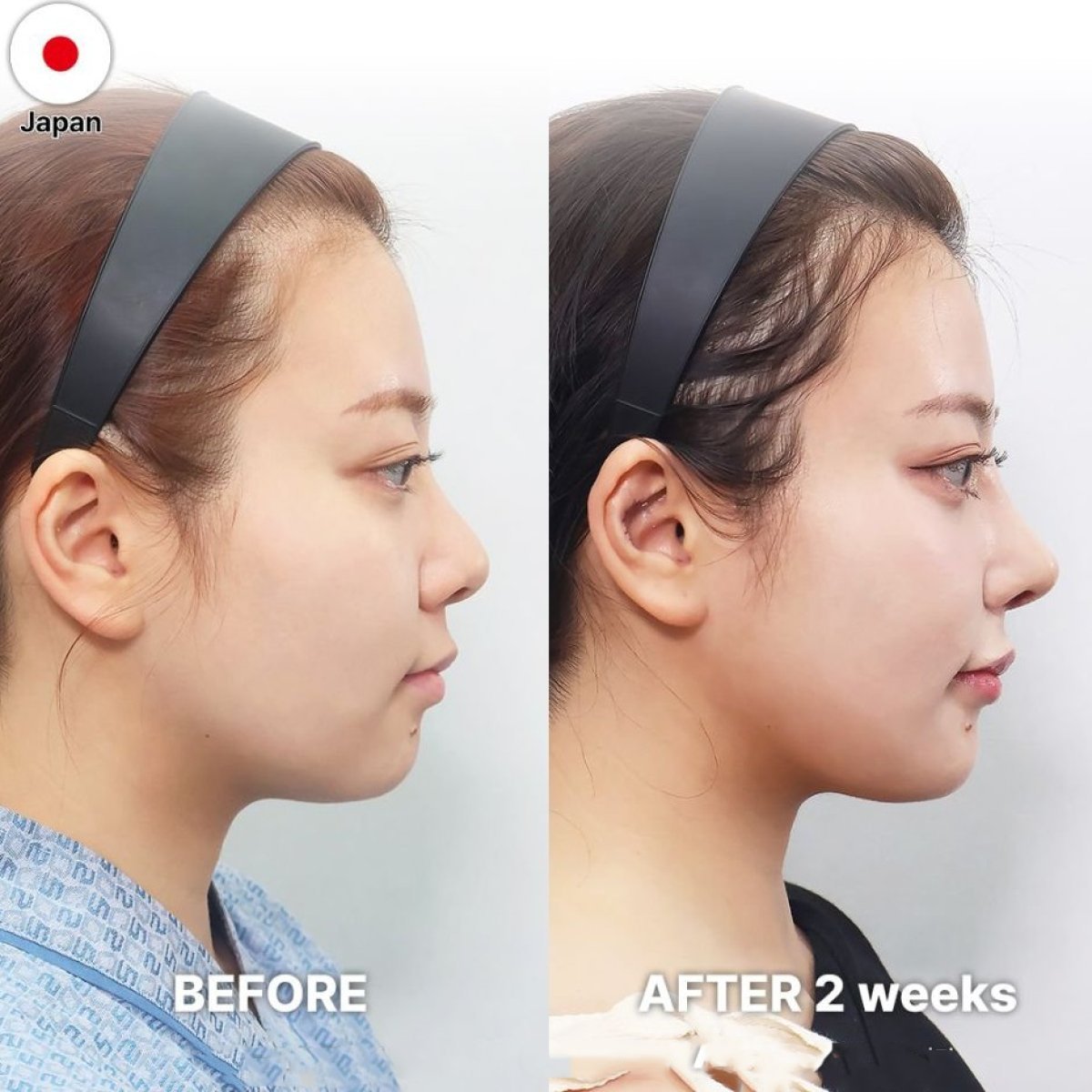 نتائج قبل وبعد عملية تجميل الأنف التصحيحية في Returning Plastic Surgery وتحسن شكل الأنف