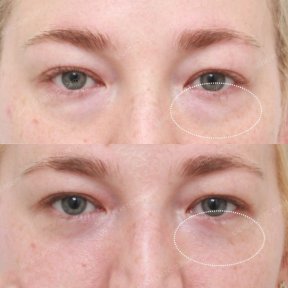 Lower eyelid blepharoplasty before and after results at SAERO Plastic Surgery, reduced eye bags