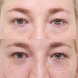 Lower eyelid blepharoplasty before and after results at SAERO Plastic Surgery, reduced eye bags