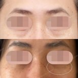 Lower eyelid blepharoplasty before and after results at SAERO Plastic Surgery, reduced eye bags