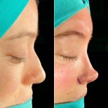 Vorher-nachher-Ergebnisse der Alarplastik in der Private Yüzyıl Hospital, Nasenflügelkorrektur