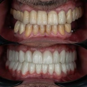 Smile makeover Vorher-Nachher-Ergebnis bei Adem and Havva Medical Center, weiße Zähne