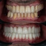 Smile makeover Vorher-Nachher-Ergebnis bei Adem and Havva Medical Center, weiße Zähne