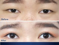 Before and after blepharoplasty results at Dr. Chen Surgery Hospital International Center