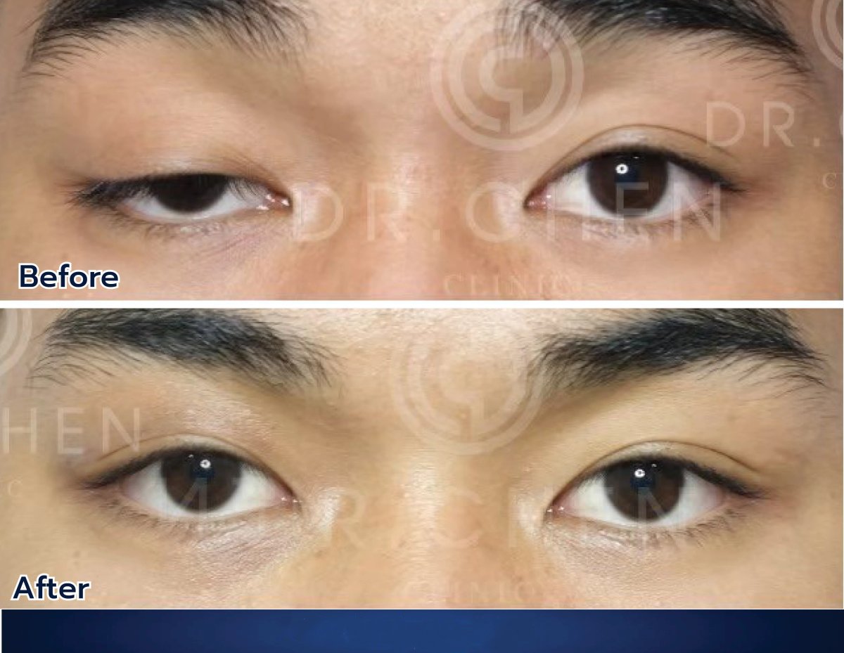 نتائج رأب الجفن قبل وبعد في Dr. Chen Surgery Hospital International Center
