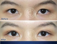 Blepharoplasty before and after results at Dr. Chen Surgery Hospital International Center