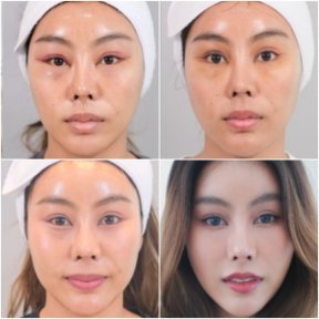 Endoscopic facelift before and after results at Dr. Chen Surgery Hospital International Center