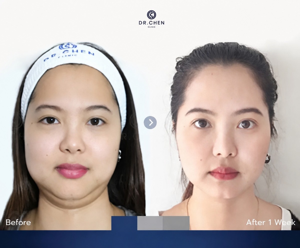 نتيجة شفط الدهون قبل وبعد في Dr. Chen Surgery Hospital International Center، تحديد الوجه
