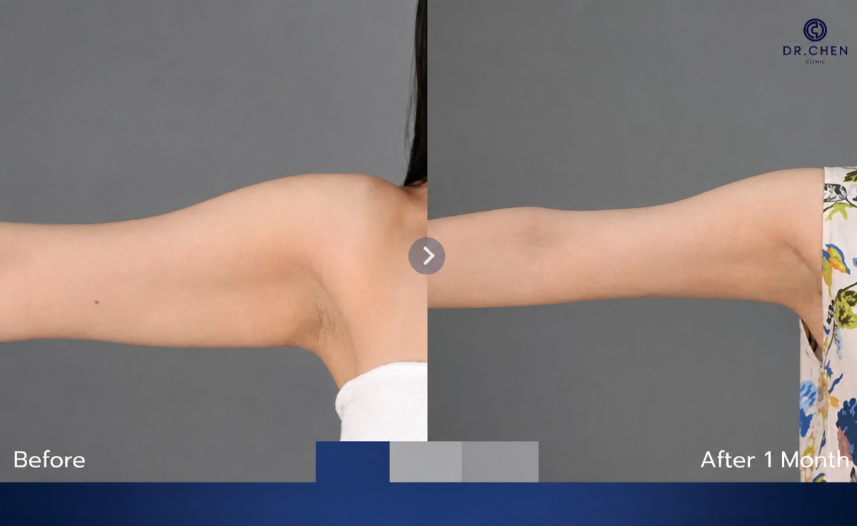 نتائج شفط دهون الذراعين قبل وبعد في مركز Dr. Chen Surgery Hospital International Center