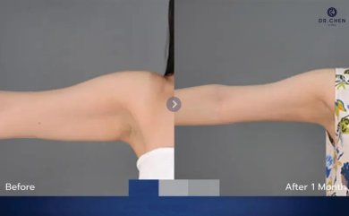 Before and after arm liposuction results at Dr. Chen Surgery Hospital International Center