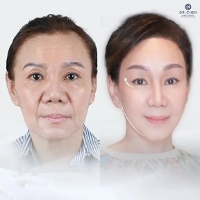 Facelift before and after results at Dr. Chen Surgery Hospital International Center, facial rejuvenation