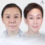 Facelift before and after results at Dr. Chen Surgery Hospital International Center, facial rejuvenation
