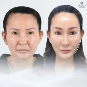 Facelift before and after results at Dr. Chen Surgery Hospital International Center, facial rejuvenation